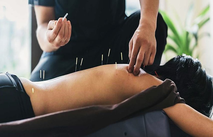A practitioner placing acupuncture needles along the back of a person lying on a treatment table
