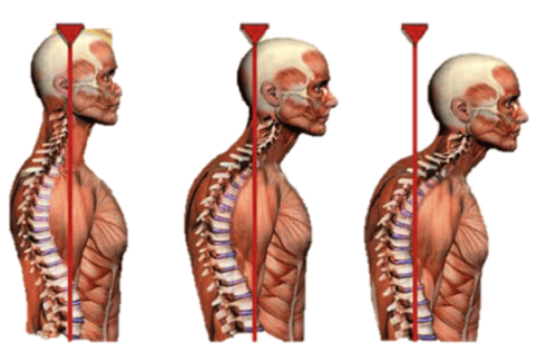Anatomical illustration comparing three side views of head, neck and upper back posture against a vertical red line