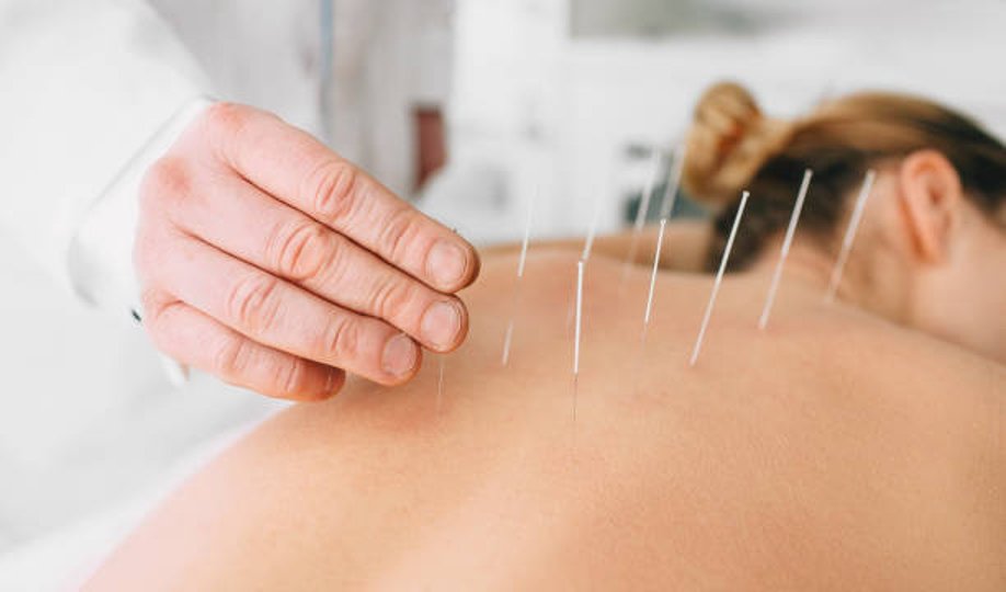 A practitioner's hand beside acupuncture needles placed along a woman's upper back