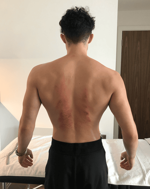 A man's bare back seen from behind, with reddened marks running down both sides of the spine, beside a treatment couch
