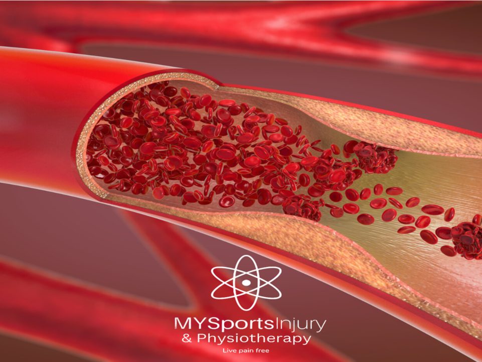 Illustration of a cut-away blood vessel filled with red blood cells, with the MY Sports Injury logo