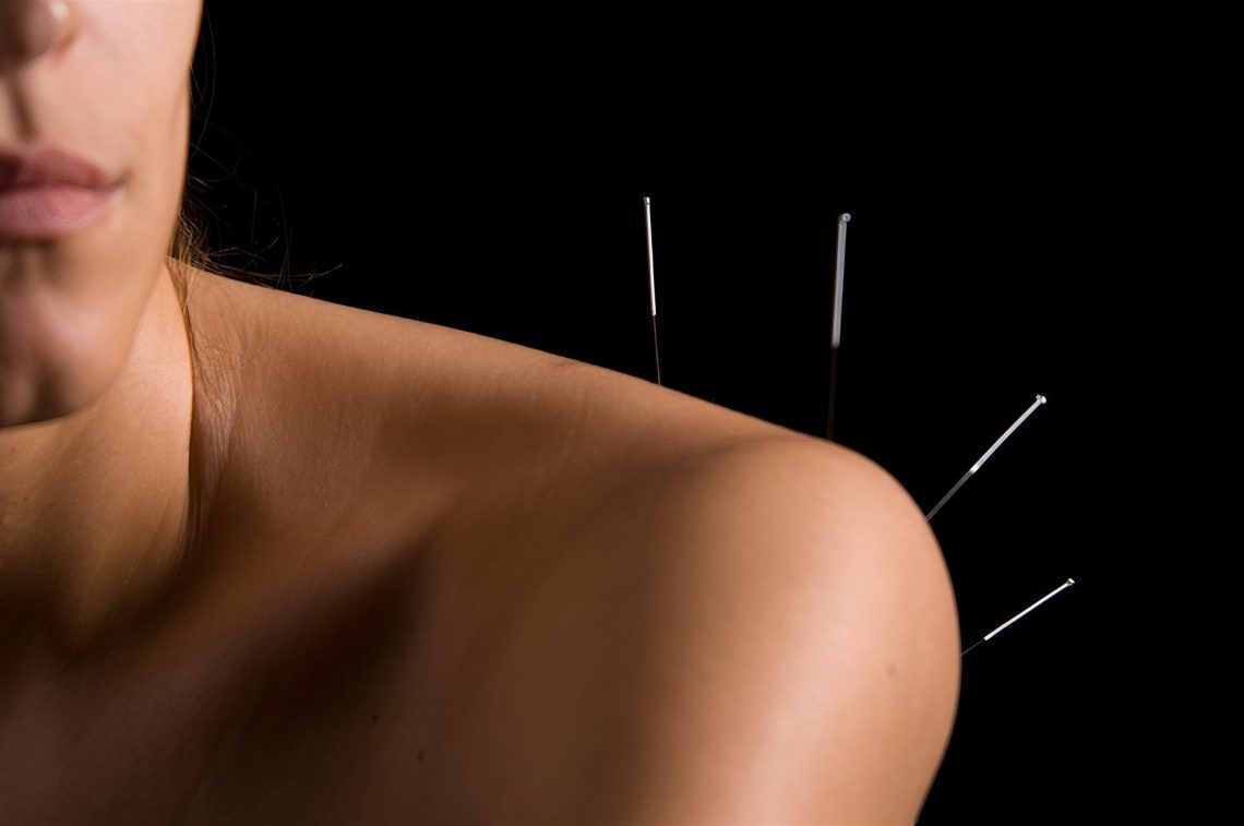 Fine acupuncture needles placed along a patient's shoulder and upper back against a dark background.