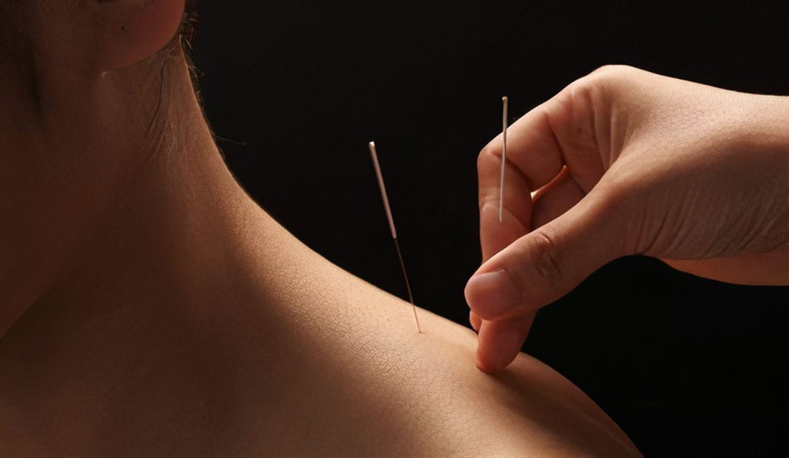 A practitioner placing an acupuncture needle into a patient's neck and shoulder.